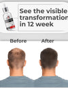 MNT Advanced Hair Growth Serum with 2% Lindera Strychnifolia 3% Redensyl, 4% Anagain, 2% Procapil | Hair Growth Serum for Scalp | Hair Growth Serum for Women & Men | 30 ml
